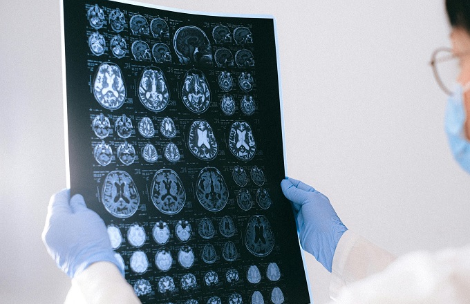 Rechazan conceder la incapacidad permanente a una trabajadora con epilepsia por no quedar acreditado el número de crisis que padece al mes