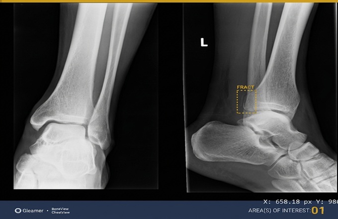BoneView de Gleamer